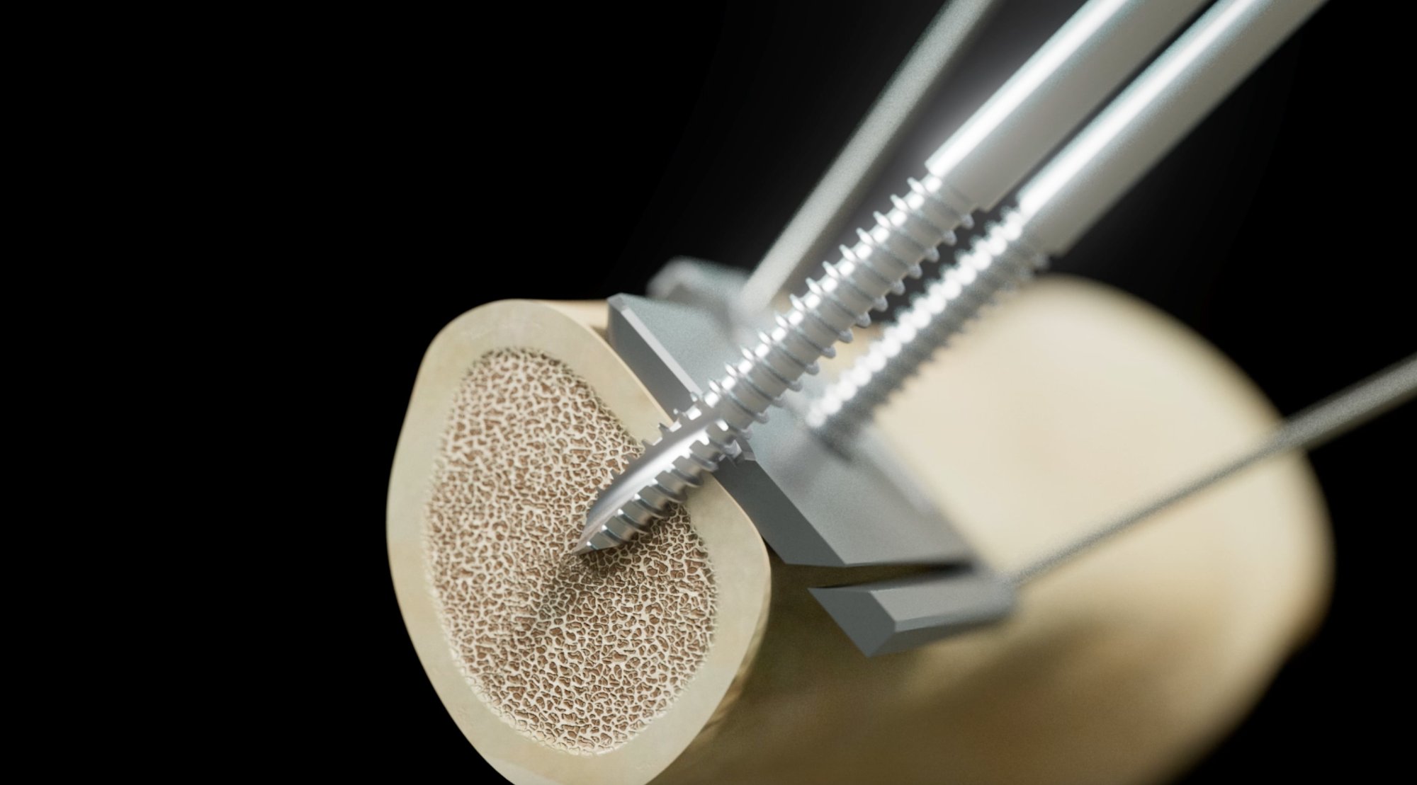 Excelsior System — Bone Fixation Detail